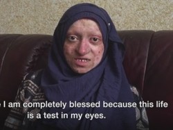 Karena Kelainan Genetik, Kulit Wanita Ini Rentan Copot dan Terluka