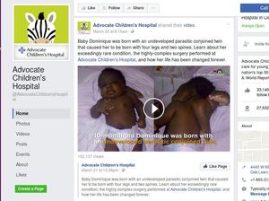 Operasi Sukses, Bayi dengan 4 Kaki dan 2 Tulang Belakang Bisa Hidup Normal