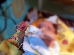 Bayi Berusia 3 Minggu di Sukabumi Ini Lahir Tanpa Tempurung Kepala