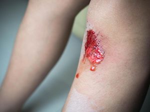 Bocah Vietnam Menangis dan Berkeringat Darah Saat Alami Stres