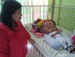 Farhan, Penderita Hydrocephalus di Banyuwangi Jalani Operasi