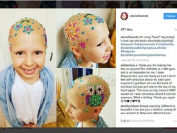 Meski Gundul karena Sakit, Bocah Ini Semangat Ikuti Crazy Hair Day