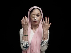 Potret Korban Serangan Air Keras Pemenang Sony World Photography Awards