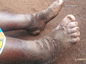 Beragam Mitos dan Fakta Seputar Kaki Gajah