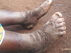 Beragam Mitos dan Fakta Seputar Kaki Gajah