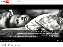 Bocah Gizi Buruk Asal Pandeglang yang Dulu Ada di Video Iwan Fals