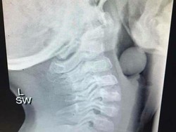 Foto X-ray Anggur Tersangkut di Kerongkongan Anak Ini Jadi Viral