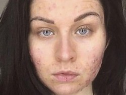 Cerita Wanita yang Wajahnya Dipenuhi Jerawat dalam Semalam