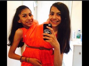 Kisah Kembar Dempet yang Tak Terpisahkan Hingga Remaja