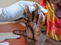 Tiga Negara Lakukan Vaksinasi Massal Malaria Pertama di Dunia