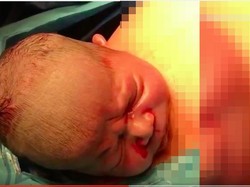 Proses Bayi Lahir Melalui Operasi Caesar Alami Ini Jadi Viral