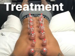 Ketika Neymar Jalani Terapi Bekam