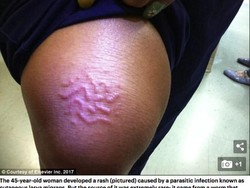 Hii! Di Bawah Kulit Perempuan Ini Bersemayam Cacing Parasit