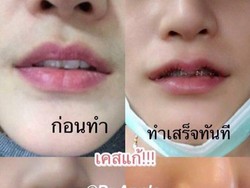 Tren di Thailand, Wanita Operasi Bibir Agar Mirip Tanduk Kerbau