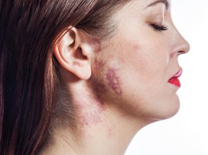 Kenali Melasma, Kondisi yang Bikin Wajah Tampak Cemong Kenali Melasma, Kondisi yang Bikin Wajah Tampak Cemong