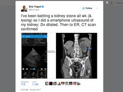 Gunakan Ponsel, Dokter Ini Temukan Batu Ginjal di Tubuhnya