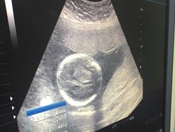 Begini Kondisi Ibu Guru Hamil Korban Lumpur Proyek di Surabaya