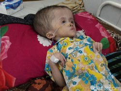 Malang Nasib Anisa, Bocah Penderita Hidrosefalus Asal Kutawaringin Bandung