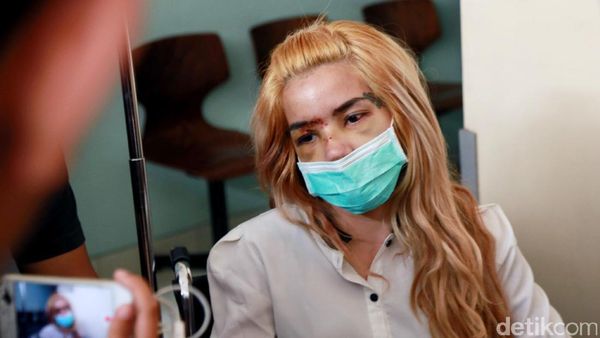 Penuh Luka di Wajah, Ini Penampakan Sheila Marcia Saat Keluar Rumah Sakit