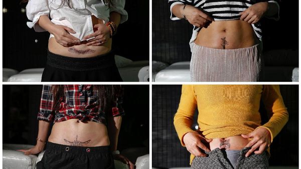 Tato Gratis untuk Kaum Ibu yang Punya Bekas Luka Caesar