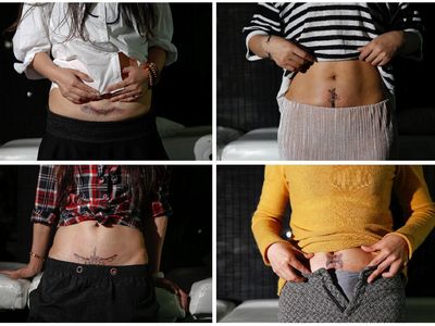 Tato Gratis untuk Kaum Ibu yang Punya Bekas Luka Caesar