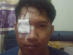 Cerita Viral Pria yang Matanya Kena Bara Rokok Saat Bermotor