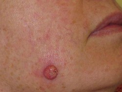 Perokok Lebih Berpeluang Kena Kanker Kulit