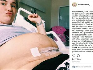 Lewat Foto, Ibu Ini Tunjukkan Perjuangan Jalani Operasi Caesar