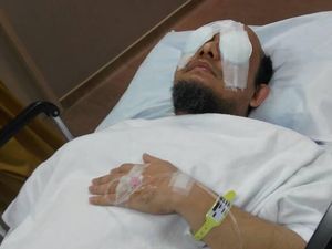 Membran Mata Kiri Novel Baswedan Alami Radang dan Pengelupasan