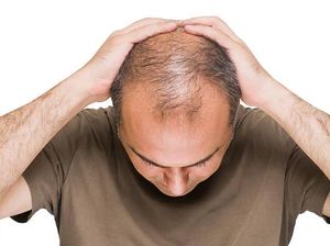 Para Pria, Ini Caranya untuk Hindari Kebotakan Dini