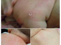 Kata Dokter Soal Video Keluar Duri dari Punggung Bayi yang Viral