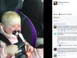 Kasihan, Wajah Bayi Ini Kena Luka Bakar karena Tabir Surya