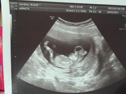 Bayinya Diprediksi Lahir Cacat, Begini Cara Pasangan Ini Merespons