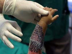 Dokter Gunakan Kulit Ikan untuk Obati Luka Bakar di Brazil