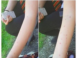 Lakukan Deodorant Challenge, Remaja Ini Alami Luka Bakar di Tangan