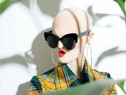 Mirip Manekin, Model dengan Kelainan Genetik Langka Curi Perhatian Dunia