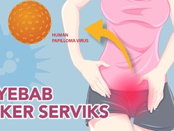Infografis: Penyebab Kanker Serviks, Kenali Agar Bisa Dicegah