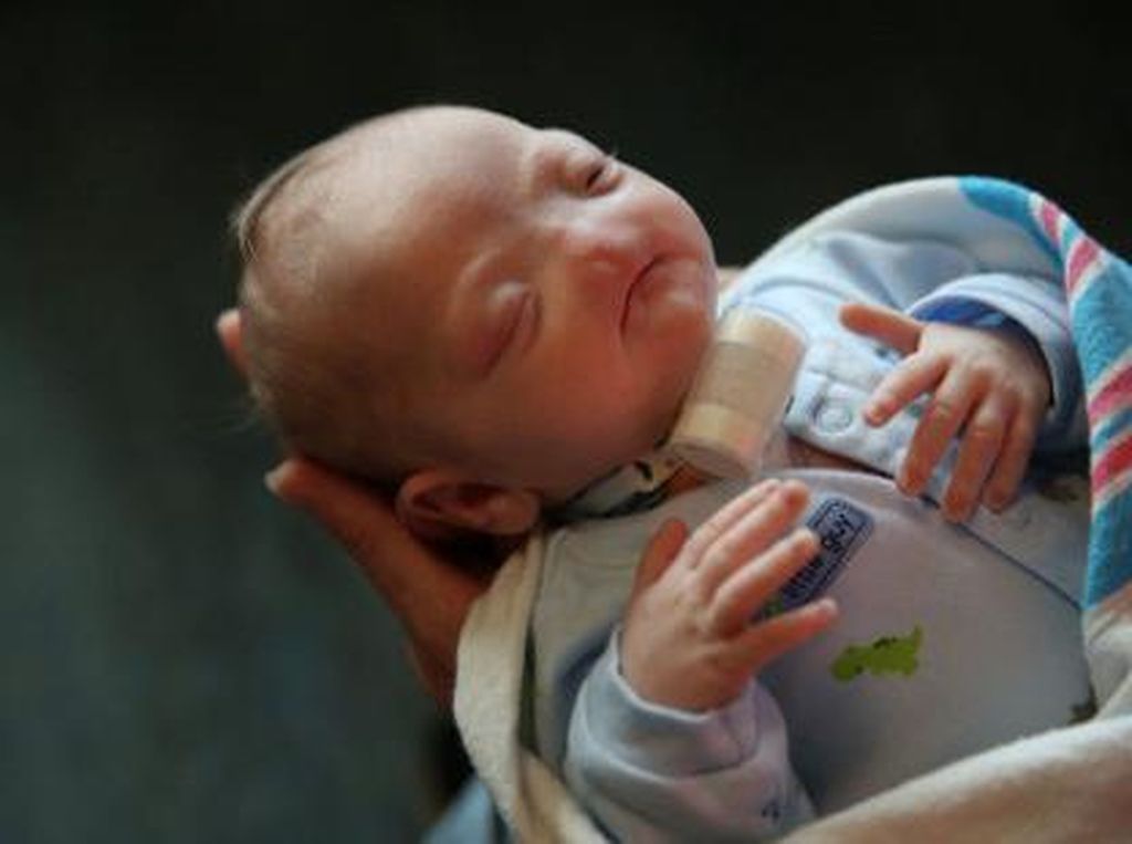 Lahir Tanpa Hidung, Bocah Berjuluk Miracle Baby Ini Akhirnya Meninggal Lahir Tanpa Hidung, Bocah Berjuluk Miracle Baby Ini Akhirnya Meninggal