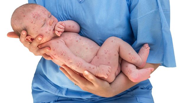 Doctor holding a beautiful newborn baby which is sick rubella