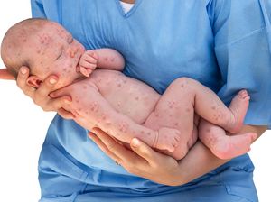 Apakah Rubella Bisa Ditularkan Melalui ASI? Apakah Rubella Bisa Ditularkan Melalui ASI?