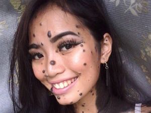 Wajah dan Tubuh Dipenuhi Tahi Lalat, Gadis Ini Ikut Kontes Kecantikan Wajah dan Tubuh Dipenuhi Tahi Lalat, Gadis Ini Ikut Kontes Kecantikan
