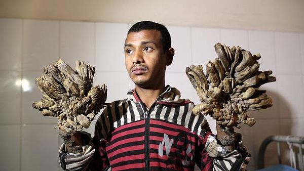 Foto Para Pengidap Sindrom Manusia Pohon Ini Bikin Kita Bersyukur