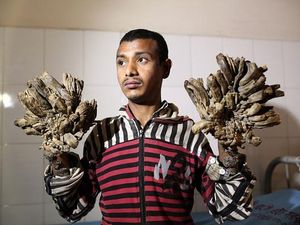 Foto Para Pengidap Sindrom Manusia Pohon Ini Bikin Kita Bersyukur