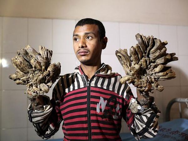 Foto Para Pengidap Sindrom Manusia Pohon Ini Bikin Kita Bersyukur