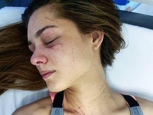 Viral, Model Venezuela Unggah Foto Luka Cakar di Wajah dan Tubuhnya