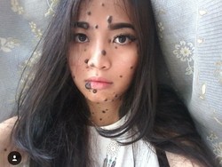 Seperti Evita, Orang-orang Ini Tubuhnya Juga Dipenuhi Tahi Lalat