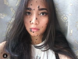 Seperti Evita, Orang-orang Ini Tubuhnya Juga Dipenuhi Tahi Lalat Seperti Evita, Orang-orang Ini Tubuhnya Juga Dipenuhi Tahi Lalat