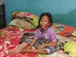 Kaki Retak Terlindas BMW, Amanda tak Trauma