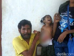Derita Olivia, Bocah di NTT yang Ususnya Dibungkus Plastik