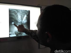 Kata Pakar Saluran Cerna Soal Benda Aneh di Perut Pria Asal Situbondo